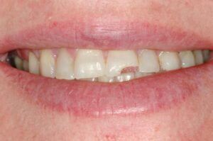 Traumi-dentali-012